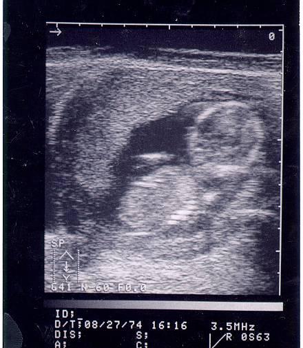 ultrasound