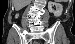 My spine MRI