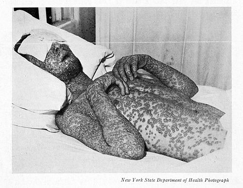 Baltimore smallpox, 1939