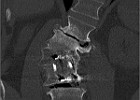 The state if my spine in 2009 shows the long term result of fusion of L3 and L3 in 1995. It's a miracle that I can still walk at all. But it was good while it lasted.